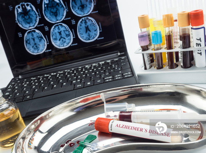 Blood sample to investigate remedy against Alzheimer disease, conceptual image