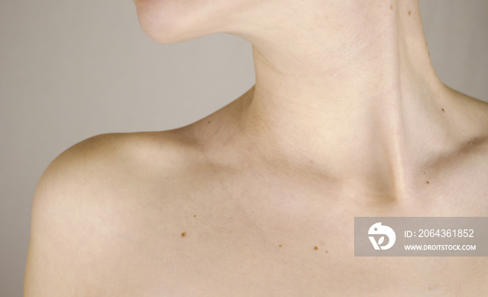 Chin neck and clavicle of a girl with lots of moles on the skin