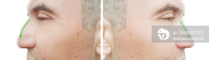 man nose hump before and after treatmen