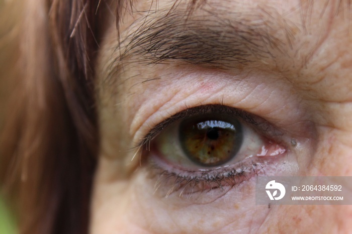 Grünes Auge einer älteren weiblichen Person mit implantierter künstlicher Linse nach Linsentrübung, 