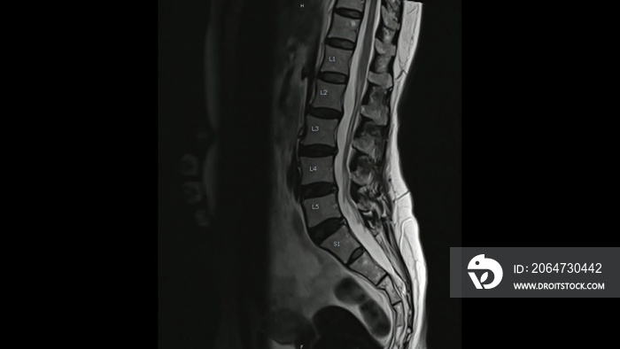 Magnetic Resonance images of Lumbar spine sagittal T2-weighted images  (MRI Lumbar spine) showing mi