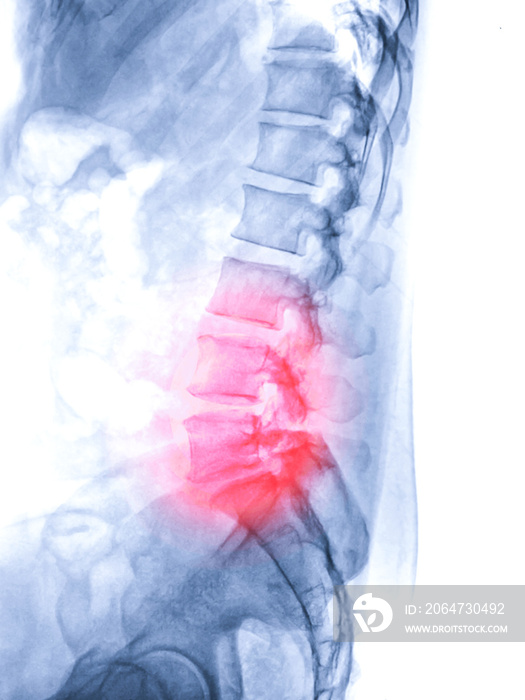 X-ray image of lambosacral spine or L-S spine lateral view from patient  lower back pain sign .