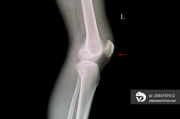 髌骨骨折患者x线片