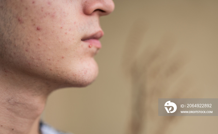 一个青春期高加索男孩皮肤上的特写肖像：他的皮肤上有严重的伤口