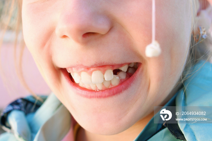 Child pulled out milk tooth with thread.