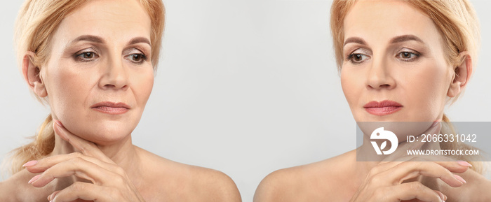 Comparison portrait of middle-aged woman before and after filler injection on light background