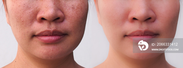 Image before and after spot melasma pigmentation facial treatment on face asian woman. Problem skincare and health concept.