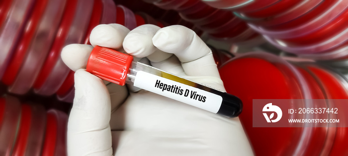 Blood sample tube for Hepatitis D virus(HDV) test, laboratory background, focus view