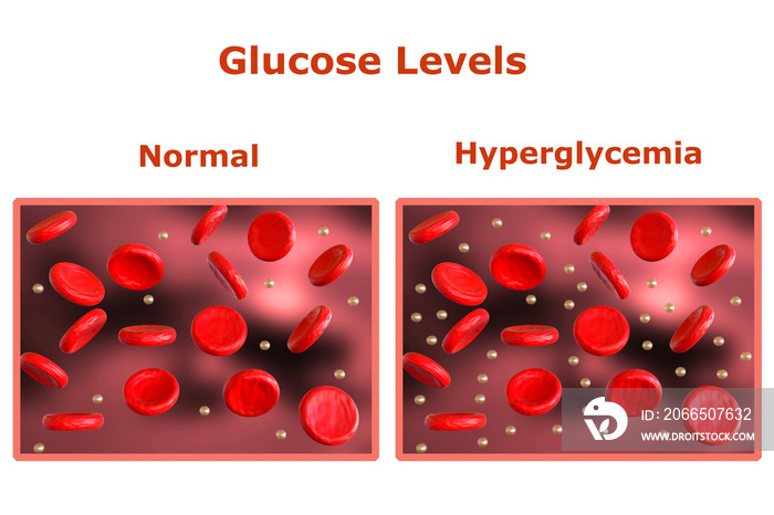 血液中的葡萄糖水平，表中显示正常水平，另一表显示糖尿病。