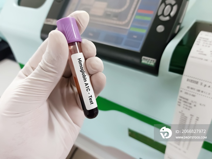 Biochemist or Lab Technologist holds Blood sample for HbA1c (Hemoglobin A1c). Diabetic treatment monitoring in the laboratory background.