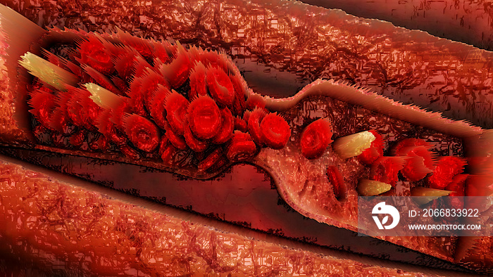 Blutplasma, Blut, Venen, Arterie, Trombose - medizinische Illustration in 3D