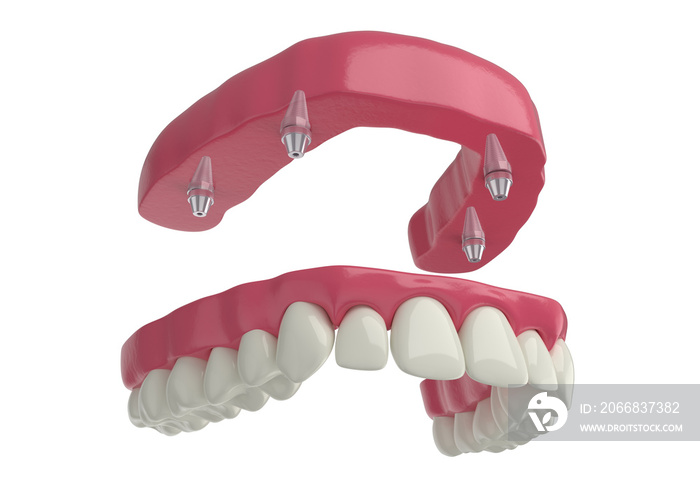 dental prosthesis, 4 overdenture implants, upper arch, 3d render