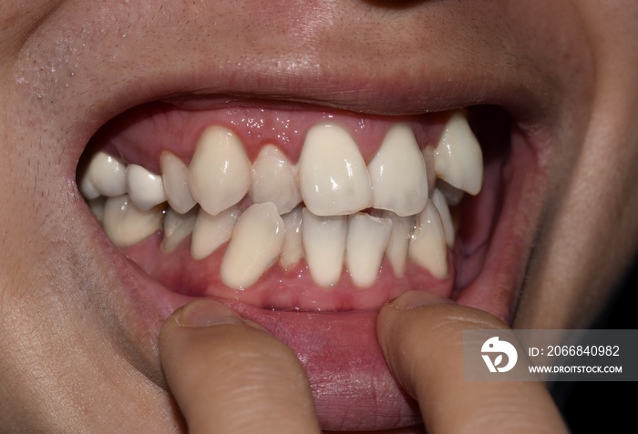 Stacked or overlapping white teeth. Also called crowded teeth.