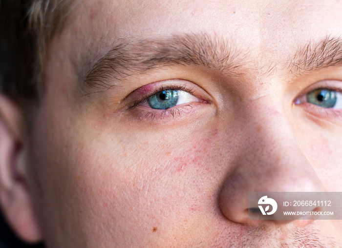 Selective focus on swollen and painful red upper eye lid with onset of stye infection due to clogged oil gland and staphylococcal bacteria. Close up right upper eyelid abscess.