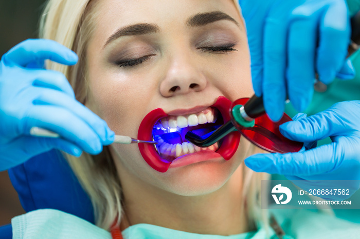 Dentists hands working on young woman patient with dental tools. Female patient with retractor at the dentist.