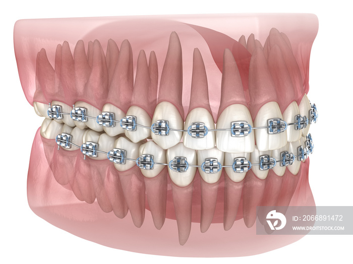 Metal braces and transparent dental model. Medically accurate 3D illustration