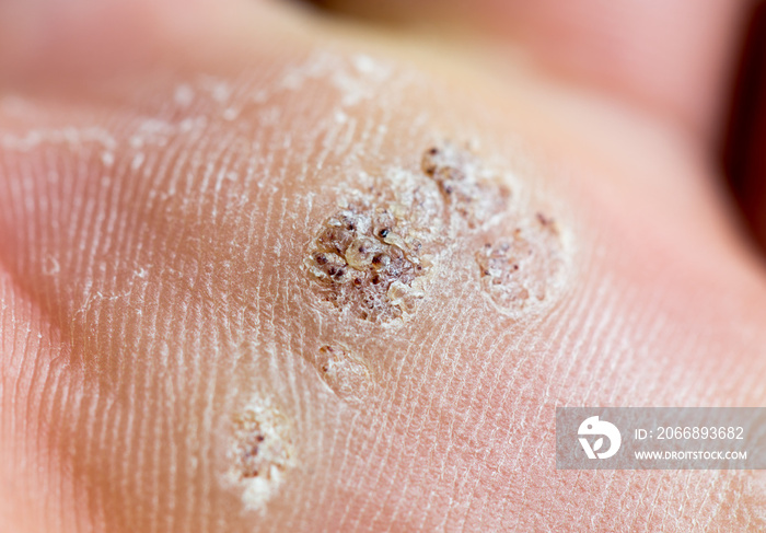 Fungus on the feet of a macro