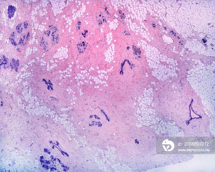 Human breast. Fibrosis