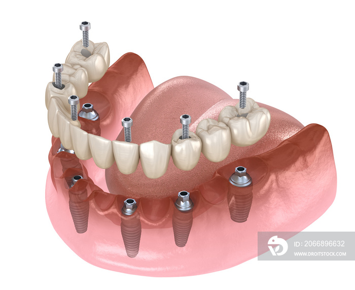 Mandibular prosthesis All on 4 system supported by implants, screw fixation. Medically accurate 3D illustration of dental concept