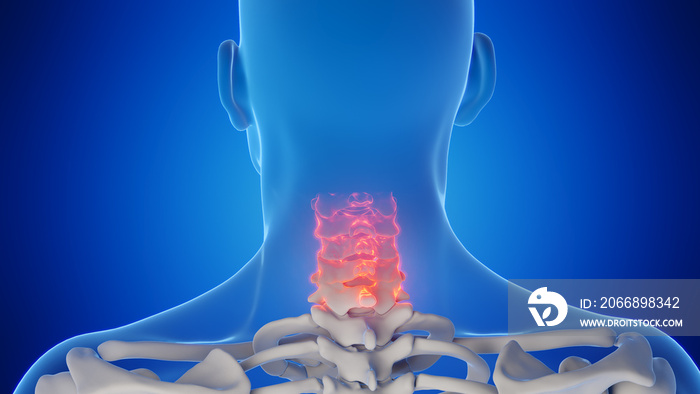 3d rendered medical illustration of a man’s cervical spine