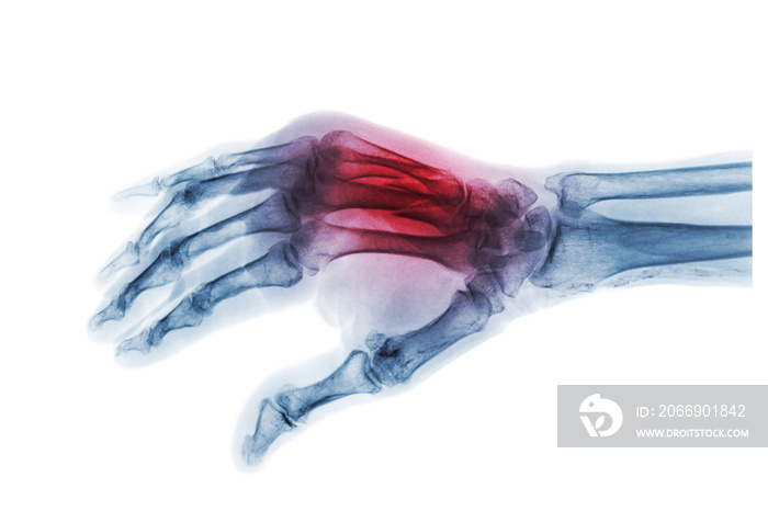 Fracture at 3rd and 4th metacarpal bone . Film x-ray of adult hands . Oblique view