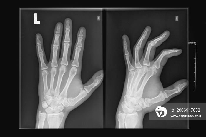 X-ray image of human hands, arm fracture