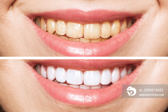 woman teeth before and after whitening. Over white background. Dental clinic patient. Image symbolizes oral care dentistry, stomatology