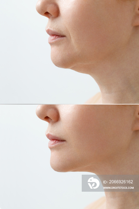 A close portrait of an aged woman before and after facial rejuvenation procedure. Correction of the chin shape liposuction of the neck. The result of the procedure in the clinic of aesthetic medicine.