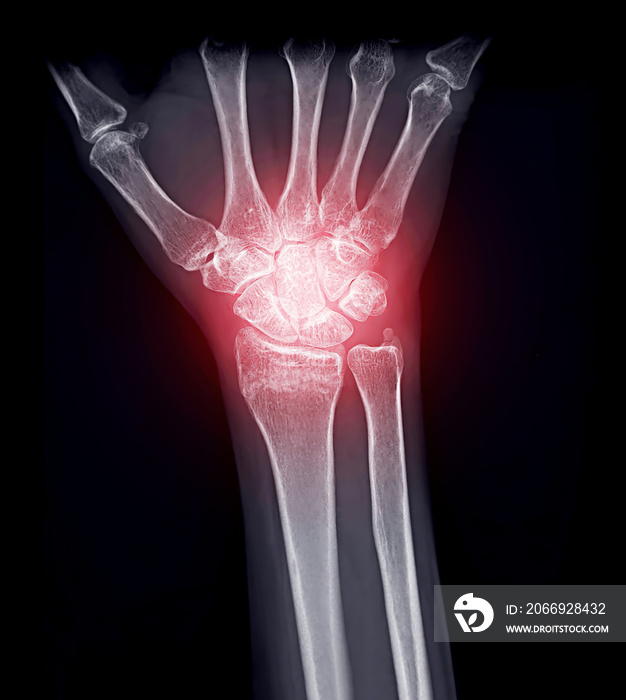 X-ray image of wrist joint Ap view for diagnostic rheumatoid arthritis .