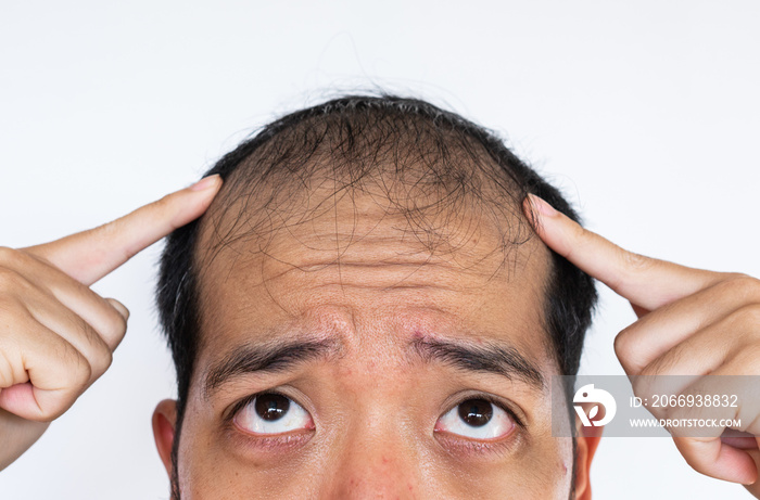 Asian man trying to looking up to his forehead, worried about his hair loss and baldness problem.