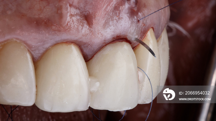 suturing the gums and fixing the crown after implantation