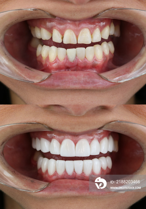 smile makeover porcelain laminate veneers result before and after