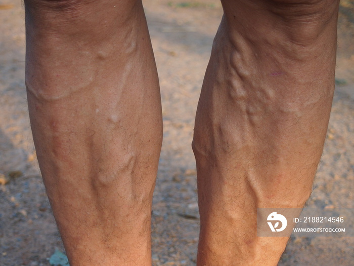 Varicose veins on the leg man using for health care concept.