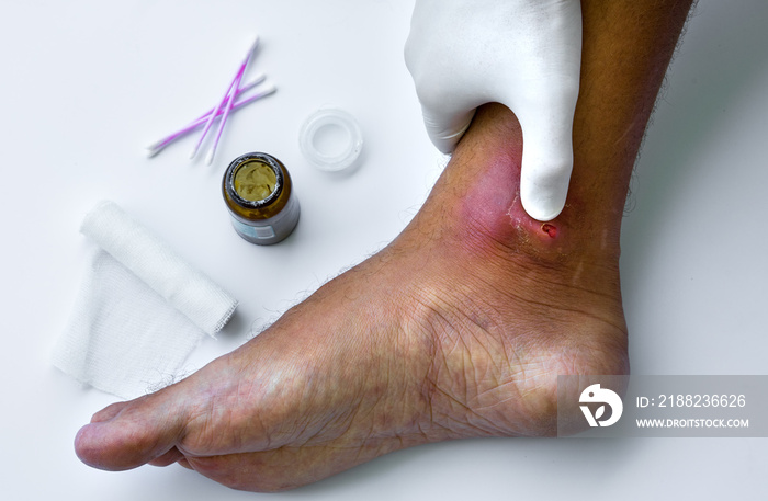 Abscesses form after bacteria. Doctor cleans purulent wound on patient’s foot.