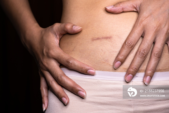 Woman showing on your stomach with a appendicitis scar, Appendicitis scar on the woman stomach.