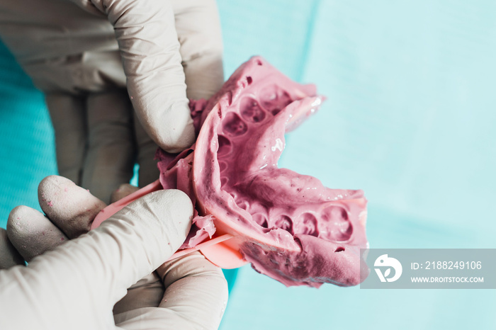 Doctor orthodontist in gloves holds a fingerprint for denture purple