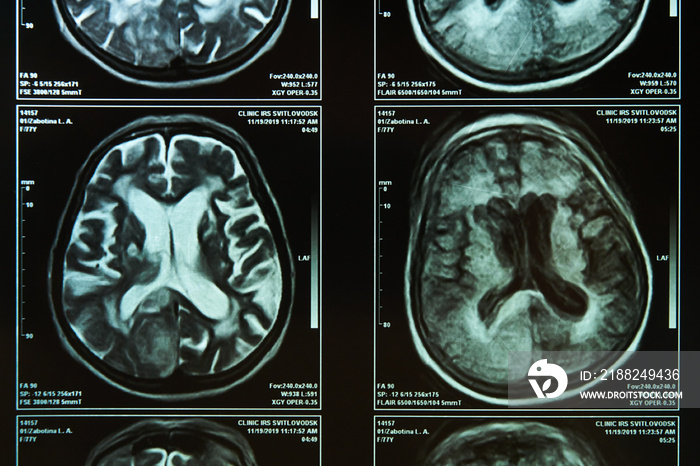 A fragment of an image of an elderly person’s brain scan on magnetic resonance imaging MRI film for neurological medical diagnosis of brain diseases