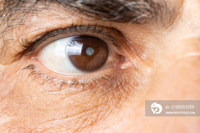 Eye of an elderly man with cataracts, clouding of the lens, macro.