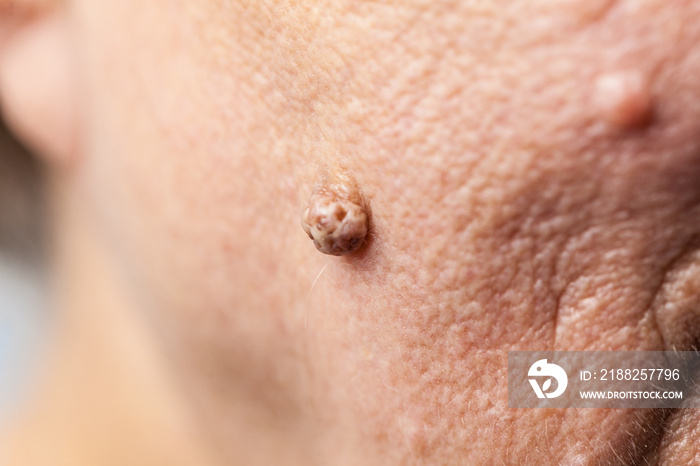 Elderly pensioner female, dermal fibroma closeup.