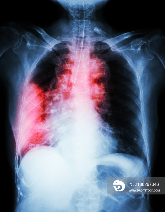 Lung cancer .  Film chest x-ray show right lung mass , wide mediastinum , pneumonia and right pleural effusion