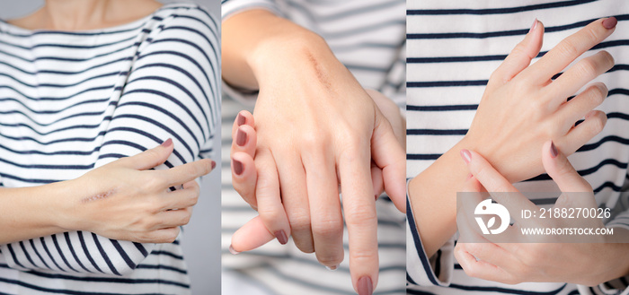 Before and after concept. A woman applying treatment cream to removal the cooking oil burn scar on her hand and It’s completely healed. Hot oil burn, Skin damaged, Derma products, Medical cream.