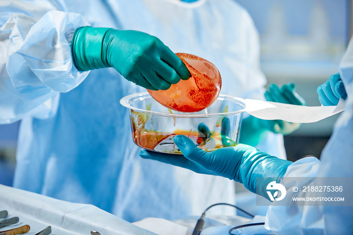 Doctor holding silicone implants for breast augmentation in operating room, closeup. Cosmetic surgery