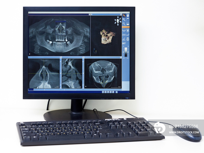 Monitor a x-ray computer setup in a dental clinic lab.