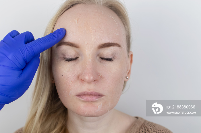 A woman examines dry skin on her face. Peeling, coarsening, discomfort, skin sensitivity. Patient at