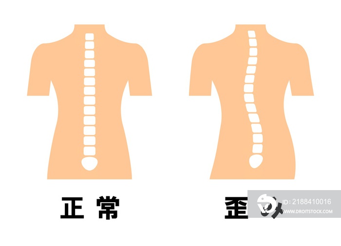 正常な背骨と歪んだ背骨