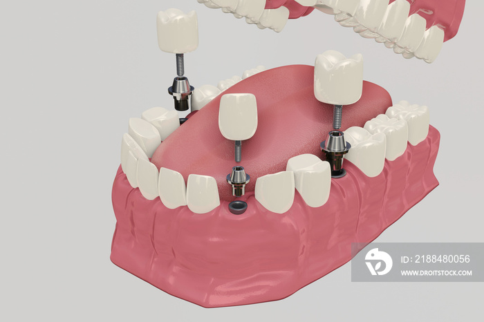 Dental Implants Treatment Procedure. Medically accurate 3D illustration dentures concept.