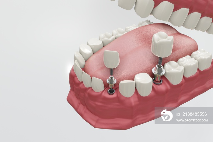 牙科植入物治疗程序。医学精确的3D插图假牙概念。