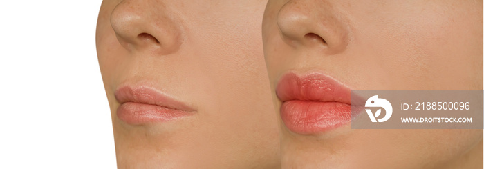 woman lips before and after augmentation