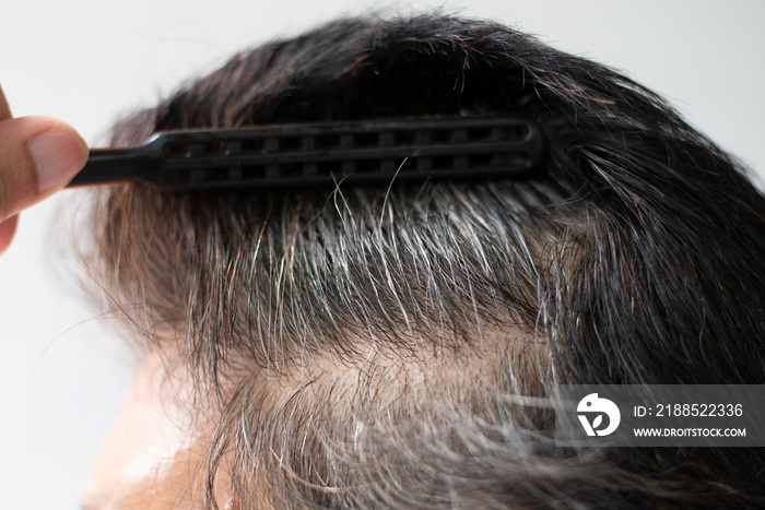 Closeup Hair grows on the head of an old woman