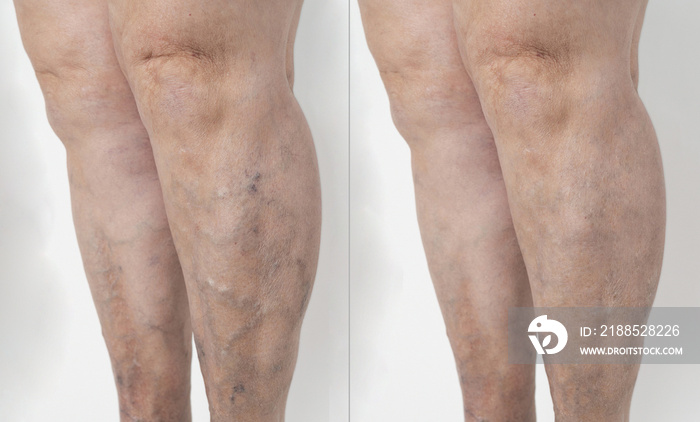 detail of one with smooth and beautiful legs of an elderly person, with varicose veins. Before and after concept. background, white background The concept of varicose disease.